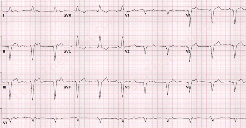 Learntheheart Com On Twitter Ventricular Pacing With Complete