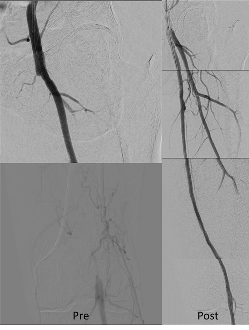 tan_guangming's tweet photo. Long SFA TO recanalized with R2P system ('U' in this case). Patient ambulatory immediately after procedure and potentially day case discharged. This is amazing! #RadialFirst #Ulnarfirst #R2P #PADRadialFirst @CUHKMedicine @terumobct @krosenfieldMD https://t.co/7nq8napusy