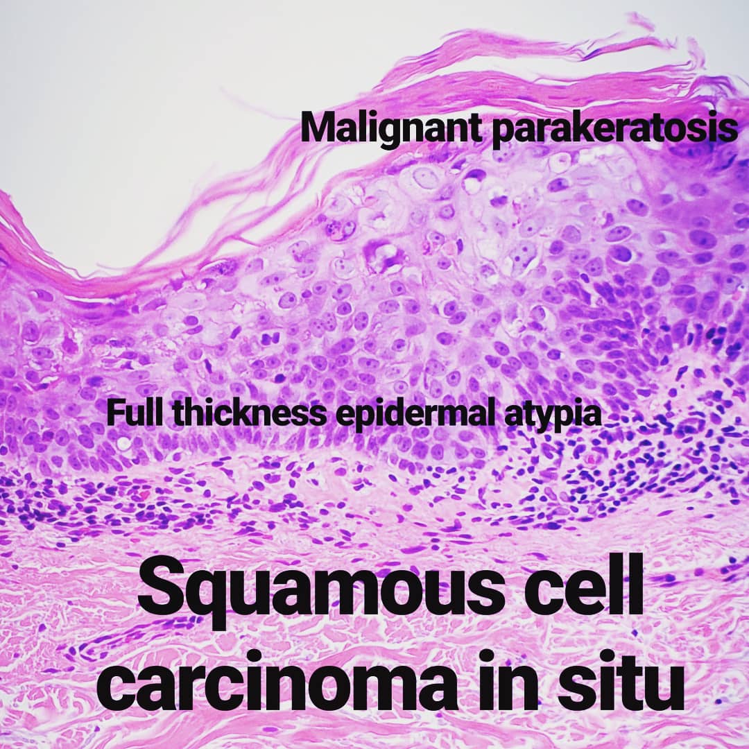 squamous cell carcinoma in situ histology