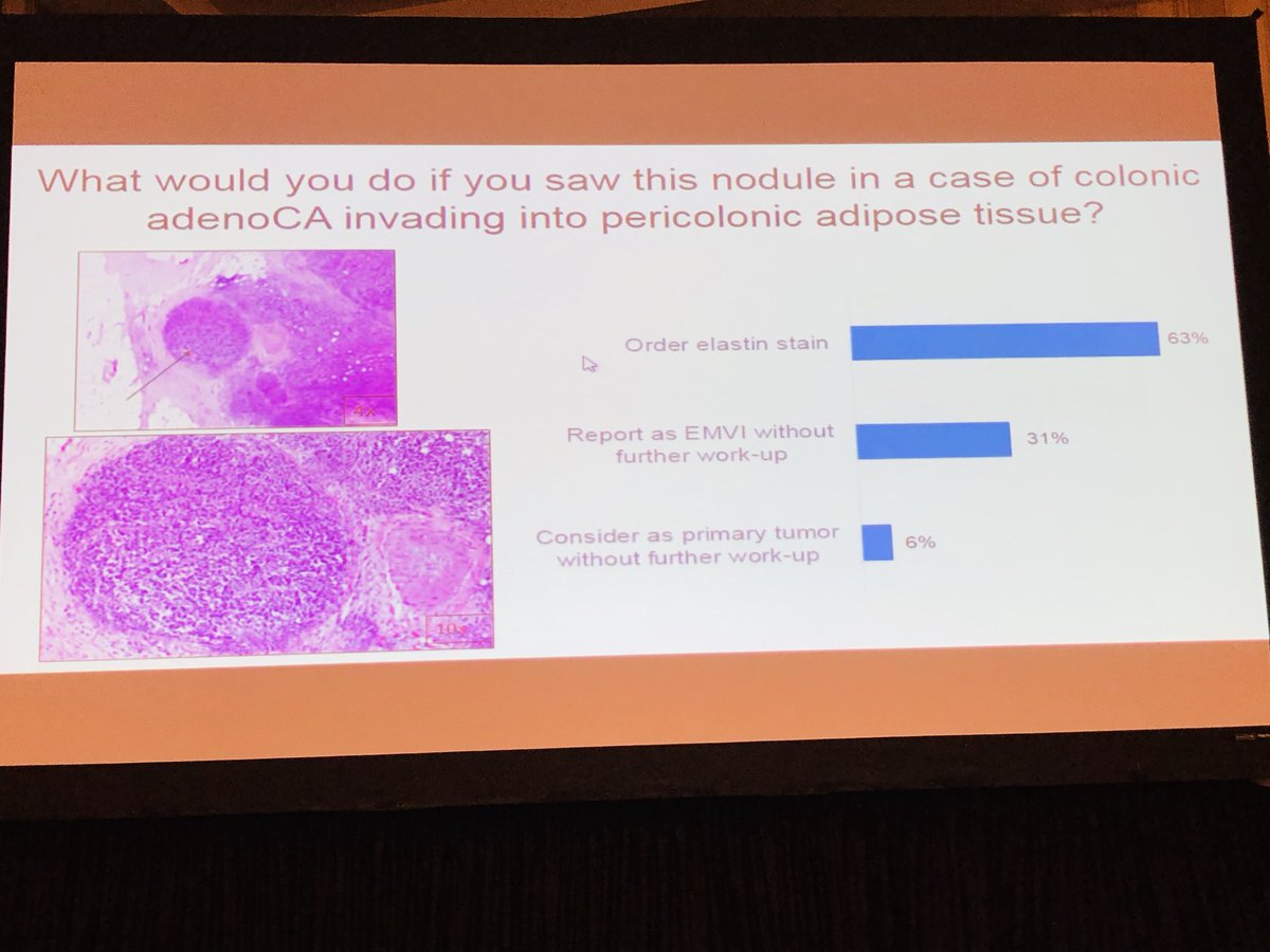 CArnoldMD's tweet photo. The latest on Extramural large vessel venous invasion in CRC by Dr Purva Gopal from @UTSW_GIpath at @USGIPS.  Look for the orphan arteriole and protruding tongue sign. discussion: when to order elastin, confounding issues, when EMLVI in or out of tumor. @TheUSCAP #uscap2019 https://t.co/BZrUGzTC6y