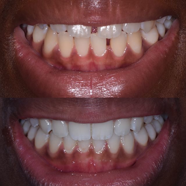 DentalChelsea's tweet photo. Another case @invisalign by @drrhonaeskander. .
..
...
#drrhona #invisalign #teeth #beauty https://t.co/4PVCmMzLg8 https://t.co/6beSXHsjG9