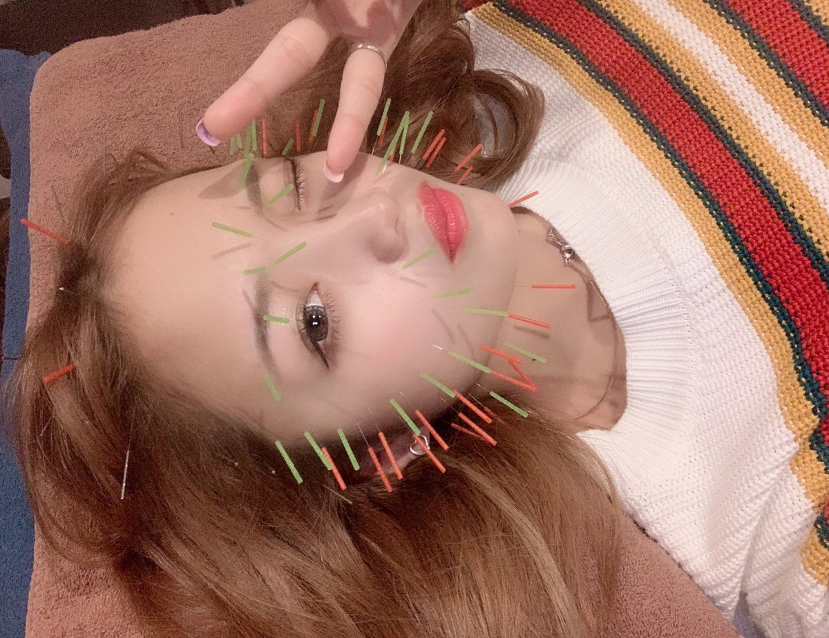 ねお はじめての美容鍼 ルディア 全然痛くない サボテンの気持ちになりました