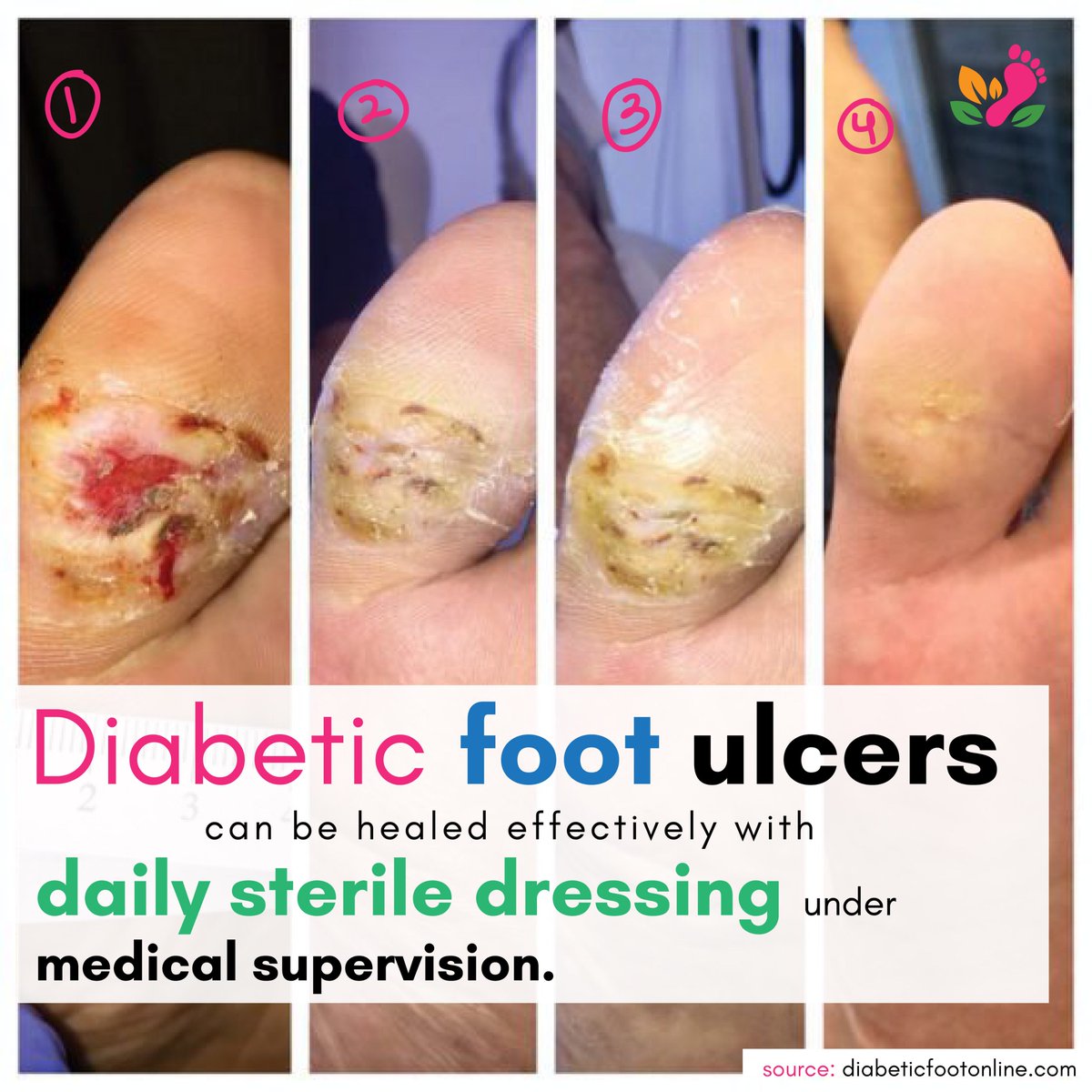 Diabetic Foot INDIA tweet media