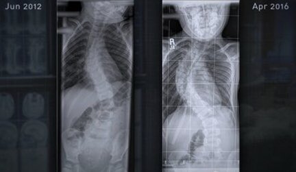 What are people’s thoughts on acceptable wait times for #scoliosis surgery once a clinical decision has been made ? Public waits can = years long.