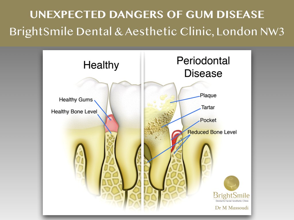 BrightSmileNW3's tweet photo. The unexpected dangers of gum disease (MedicalNewsToday)
https://t.co/DNtzZvXbRb #periodontist #dentist #dentalhygiene #PeriodontalDisease #Plaque #Calculus #Gumdisease @BrightSmileNW3 https://t.co/DY3PTVYO7Z
