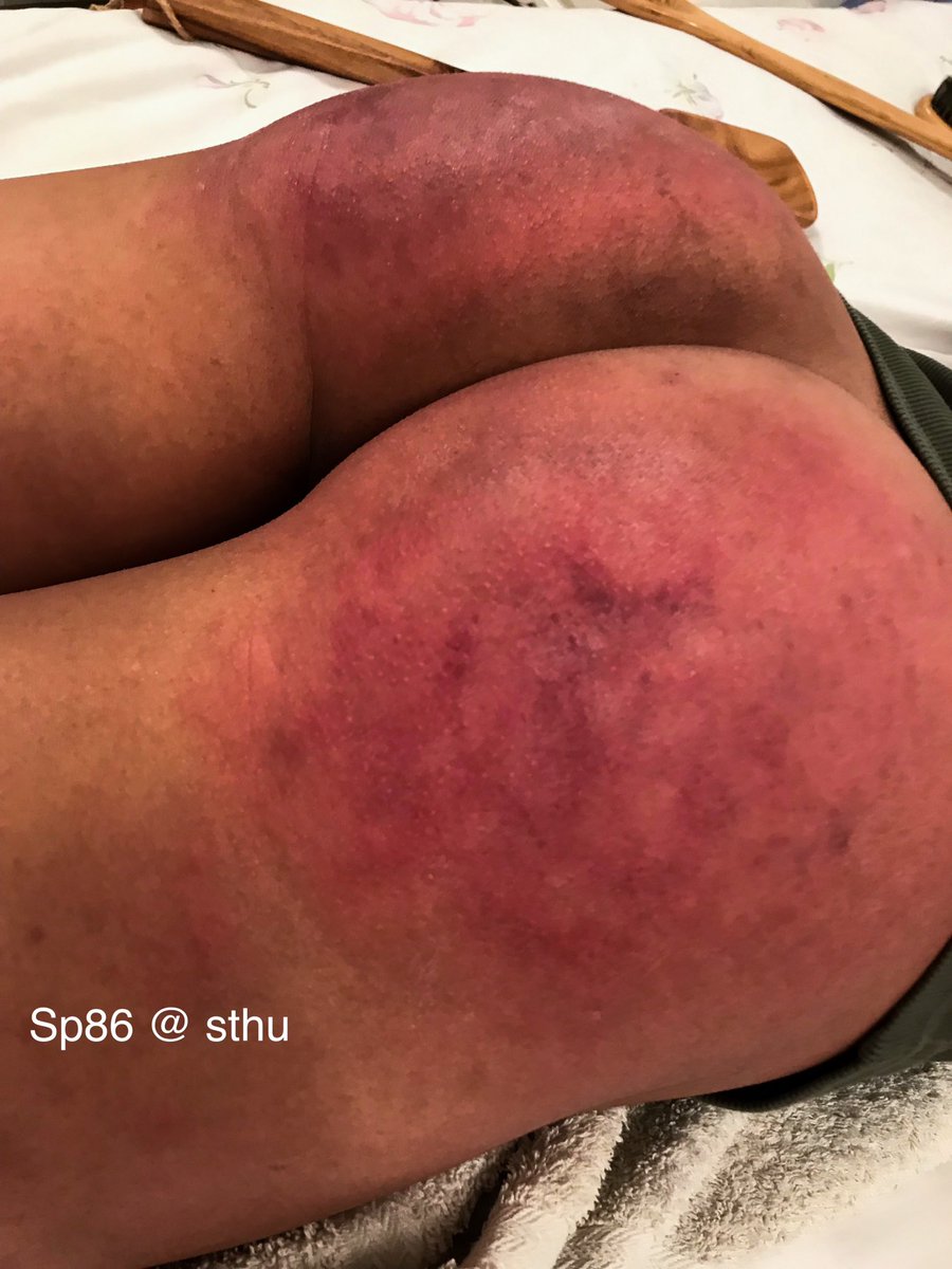 Extreme Spanking Bruise | BDSM Fetish