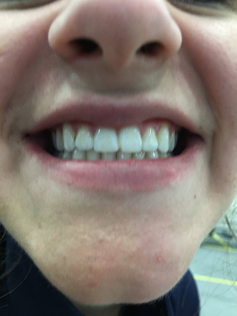 karleebrennan_'s tweet image. HAPPY BIRTHDAY @kateerwin001 MISS YOU HOMIE #toothpic