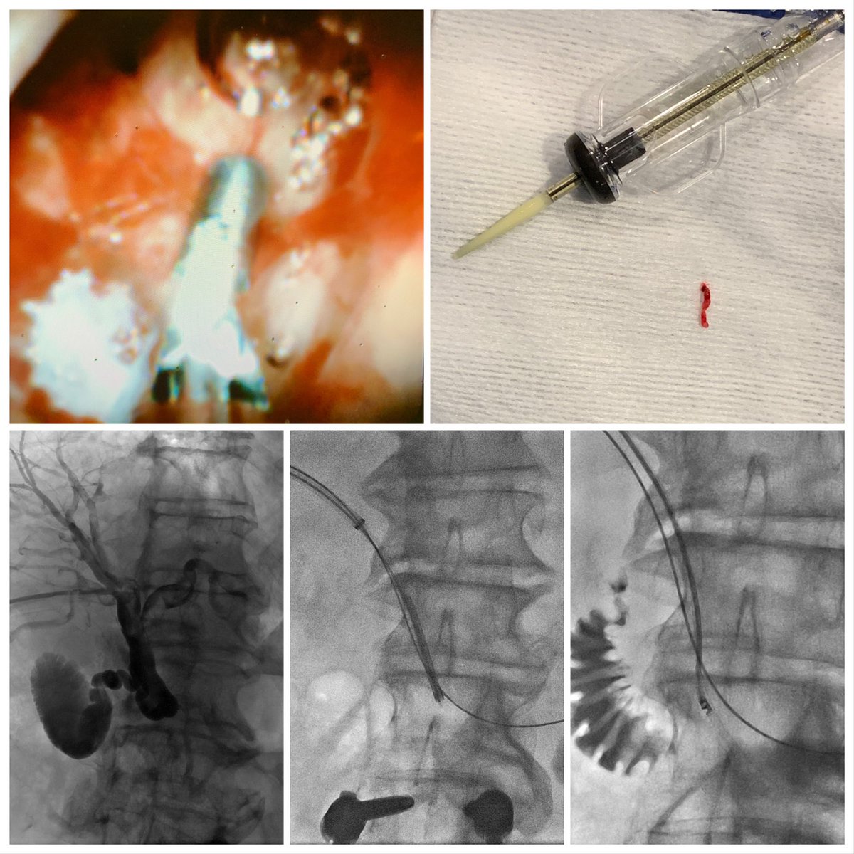 ZagumBhatti's tweet photo. Percutaneous transbiliary #Spyglass endoscopic forceps and #Hawkone biopsy of distal CBD stricture. @CarlosGuevaraIR @medravi @CHICKVIR @keithppereira @kmadass @SDhandMD @bsc_pi @SIRspecialists https://t.co/uvNLjND5Tk