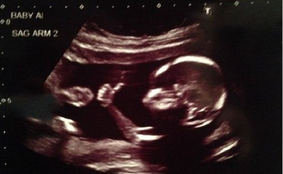 BREAKING NEWS: Georgia Legislature Passes Bill Banning Abortions After Unborn Baby’s Heart Starts Beating bit.ly/2V5LKqW #prolife #maga