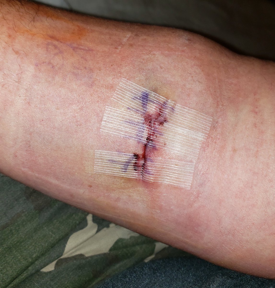 MarshWhisperer's tweet photo. 3 days post surgery. 1 hole drilled thru bone to anchor tendon, 1 screw in bone for support. Looks pretty good, considering. Feels good, considering, too. #bicepsurgery https://t.co/s7OuwDM1kz