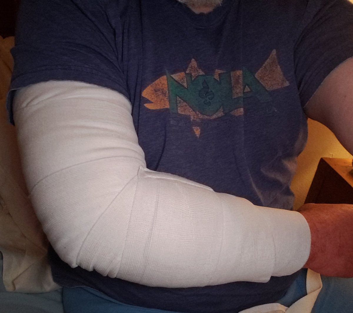 MarshWhisperer's tweet photo. 3 days post surgery. 1 hole drilled thru bone to anchor tendon, 1 screw in bone for support. Looks pretty good, considering. Feels good, considering, too. #bicepsurgery https://t.co/s7OuwDM1kz