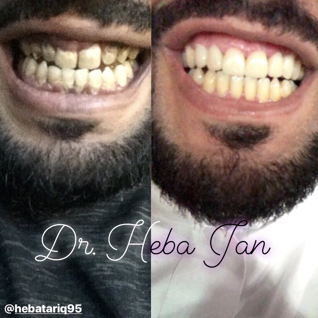 Hebajan95's tweet photo. مافي شي مستحيل✨
الحمدلله حمداً كثيراً حمداً تستديم به النعم.
كان أصعب وأحلى تحدي اختم فيه مسيرة الـ ٦ سنين، أوّل مرة كلمني فيها المريض يبغى يتعالج قلتلو صورلي اسنانك؛ قال اخاف اصورلك هيا وما تعالجيني، وبفضل من الله قدرت اعالجه واسعده وارجع ابتسامته وثقته في نفسه❤️  
اذكرو الله🙌🏼 https://t.co/a4nFZ8htNN