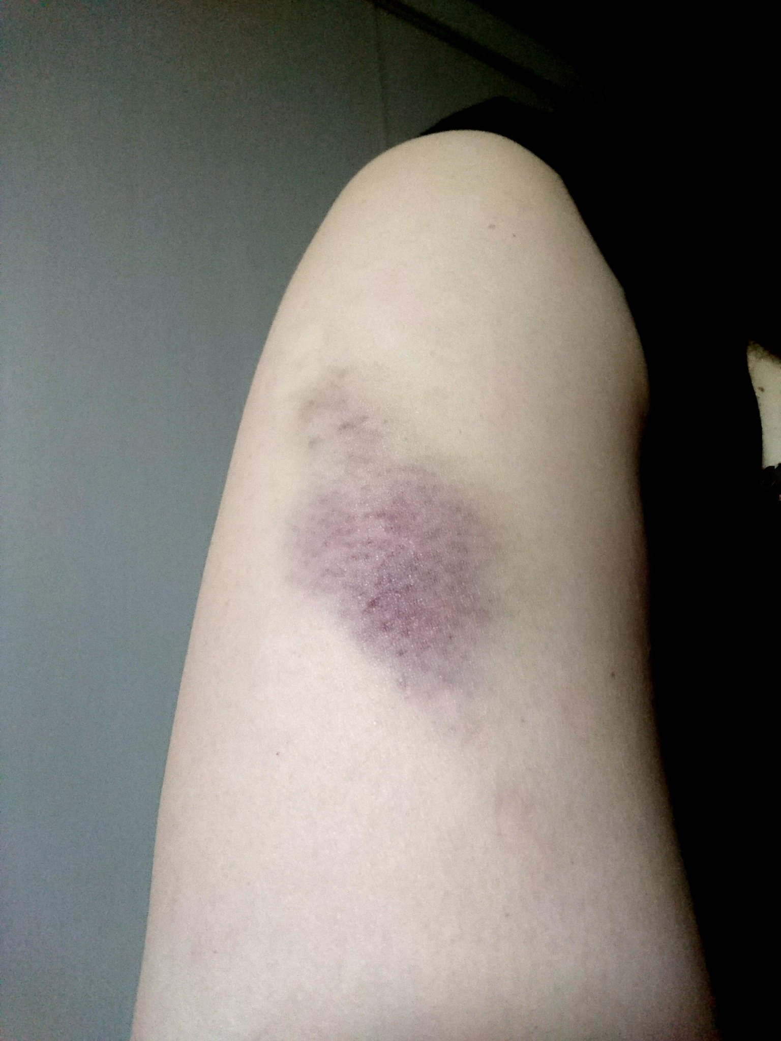 Uzivatel Ted Dora Na Twitteru 事務所移転のため段ボールの上げ下ろしをしてたら太腿の裏が筋肉痛に 毎日スクワットしてるのに何か負けた気分 それと知らない間に身体中にアザが よくｄｖ被害者の方が 写真だと酷さが上手く写らない とおっしゃるけど 自分も