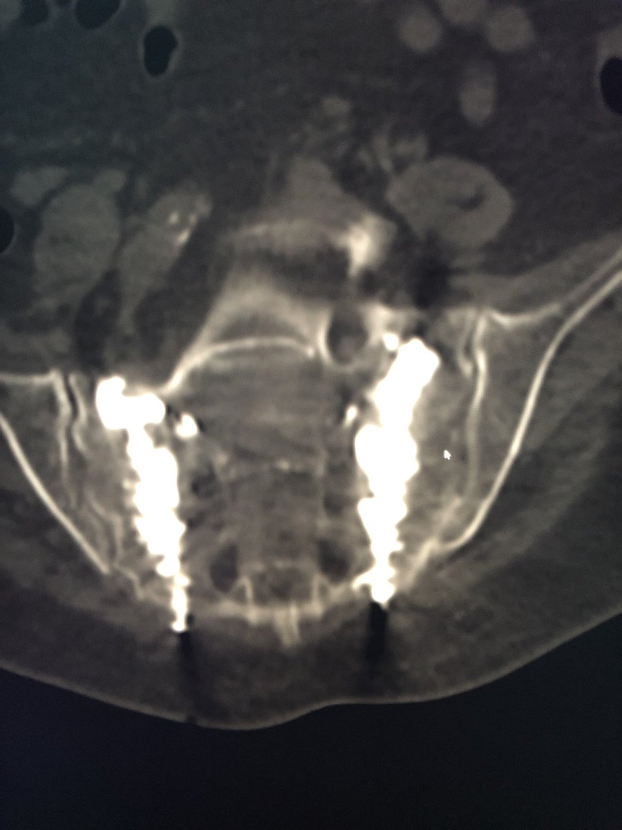 From hospitalized w intractable pain to ambulating w walker in a day, love a good #sacroplasty! #irad <a href="/_backtable/">BackTable Vascular and Interventional</a> <a href="/SIRspecialists/">Society of Interventional Radiology</a>