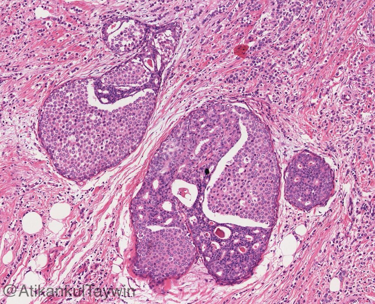 AtikankulTaywin's tweet photo. Coexistence of DCIS and LCIS (with invasive lobular carcinoma) 

True “collision” or “progression” from ductal to lobular phenotype (as a member of low grade breast neoplasia family) ❓🤪

#breastpath #pathology #surgpath https://t.co/g4kEGUHTsW