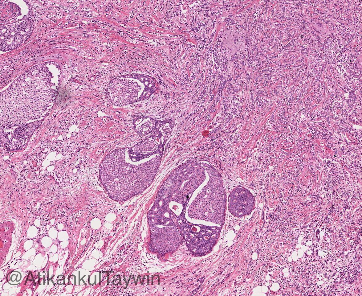 AtikankulTaywin's tweet photo. Coexistence of DCIS and LCIS (with invasive lobular carcinoma) 

True “collision” or “progression” from ductal to lobular phenotype (as a member of low grade breast neoplasia family) ❓🤪

#breastpath #pathology #surgpath https://t.co/g4kEGUHTsW