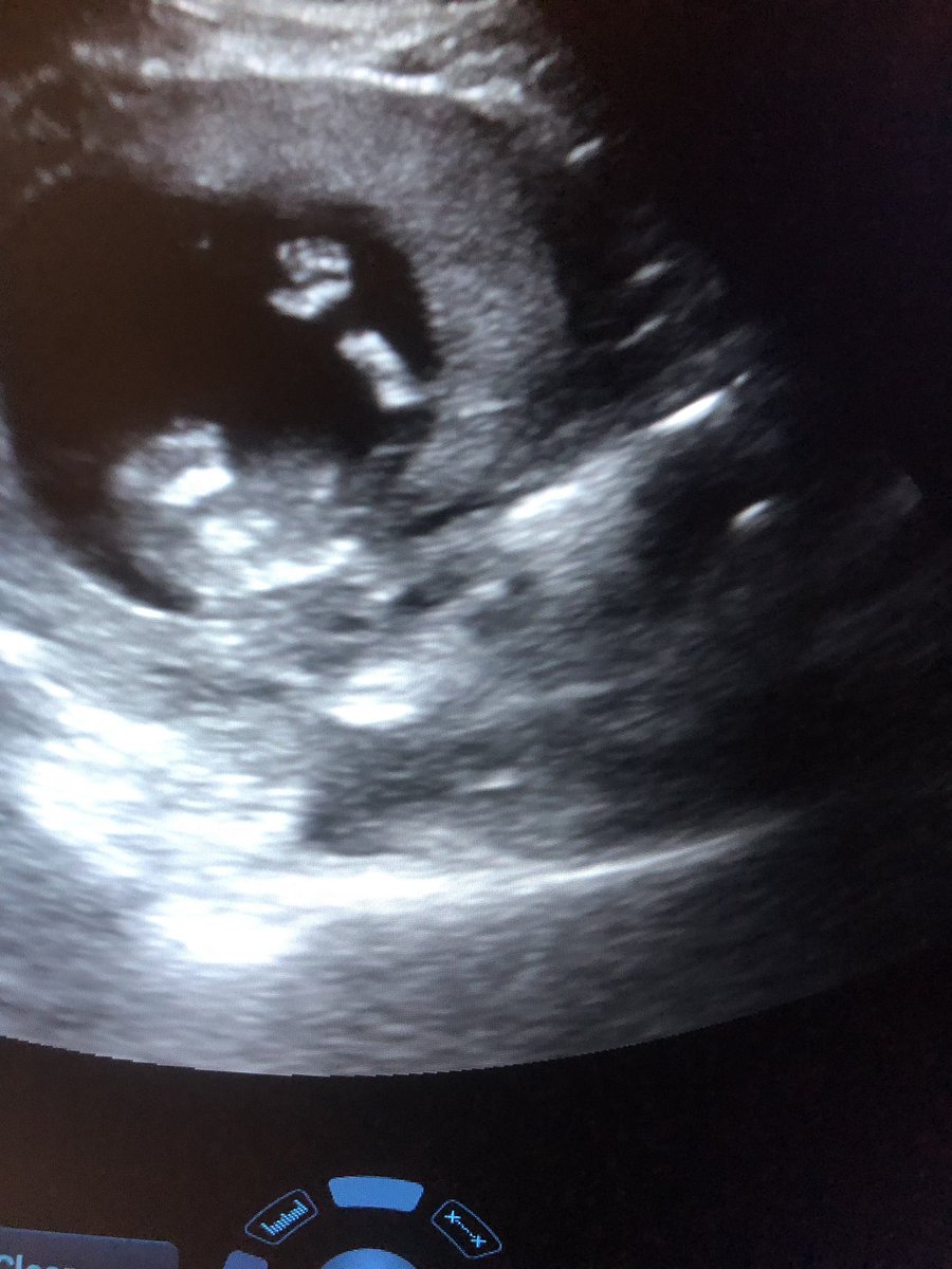 mkwhitaker14's tweet photo. Baby says heyyy! This one loves thumb sucking, punching, and kicking which makes it hard to measure a heartbeat but after several attempts, we got one. This one’s gonna be wild! https://t.co/2uL9APdcy9