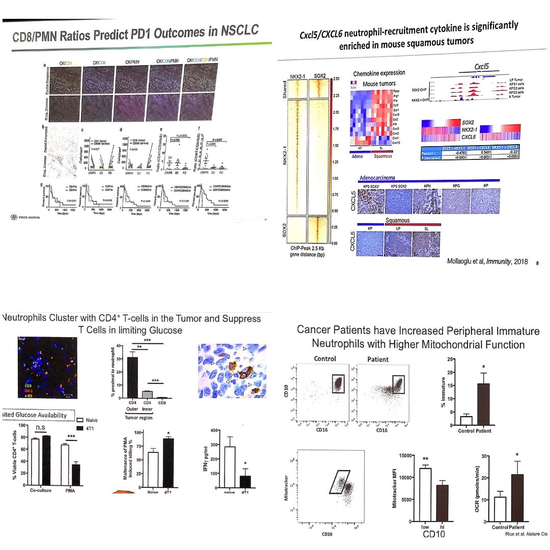 Neutrophils are an heterogeneous immune population related to squamous hystology and able to drive immunesuppression and progression to ICI in NSCLC #AACR19 #OncoAlert