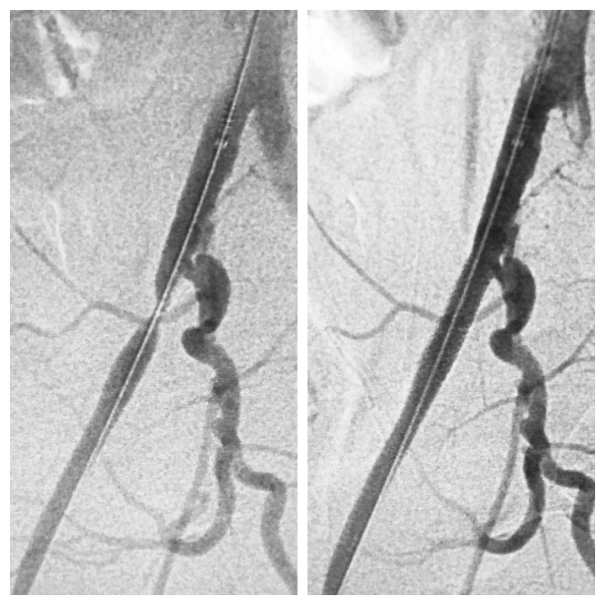 60 y/o F w/R leg #claudication. External iliac artery #stentplacement from a #radial approach. 119cm #SlenderGlidesheath from. 27mm #ExpressLDBalloonMountedStent. #MTVIR #RadialFirst #IRad #PVD #PAD #CLI #CliFighter #Podiatry #Atherosclerosis #MIIPs #Ulcer #Wound @drprestongs