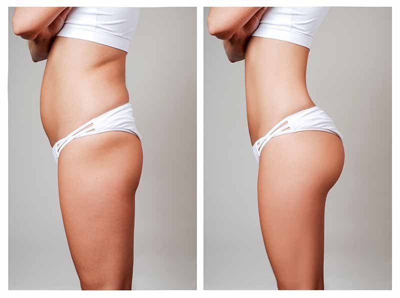 Liposuction HD in Los Angeles