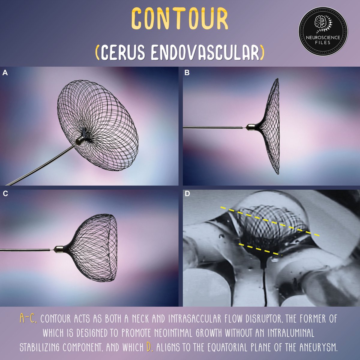 neurofiles1's tweet photo. #VascularTuesday #Neurosurgery #Endovascular #FlowDisruption #Neurology #Aneurysm #Stroke
Endosaccular flow disruption: A new frontier in endovascular aneurysm management 💡
👉🏼https://t.co/EESbDz3yrw https://t.co/P8XAwK0OKD