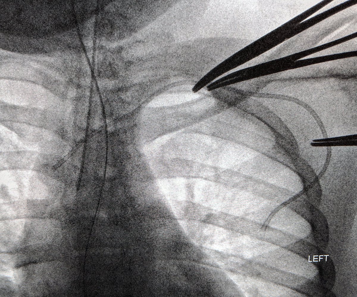 LessneVIR's tweet photo. Call from PA during port removal in septic pt- "catheter stuck!" Many options: oversheath to dissect free (didn't work here); inflate balloon inside (5mm did the trick); snare from groin. #KnowTheTricks #CathOut #PleaseGoIJ #IRad @CLTRadiology https://t.co/DRgdobLqGk