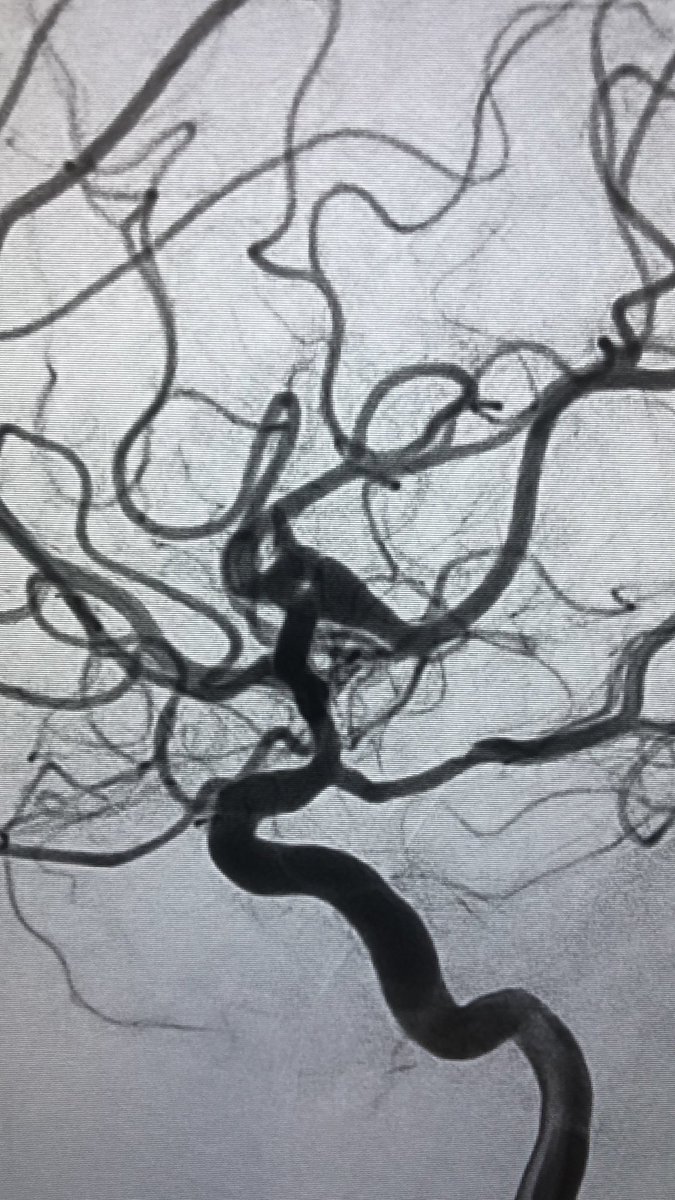RLHINR's tweet photo. Challenging case from last week: WFNS 1 SAH. Part thrombosed MCA aneurysm. Treated with half T vista and Leo BB with coils. TRA. Patient well. Will post FU imaging when performed. #FlowT #INR #aneurysm #TRA @JasonWenderoth @timbo_phillips @braincutter @NeuroRadialist https://t.co/Z2xVgqJBxo