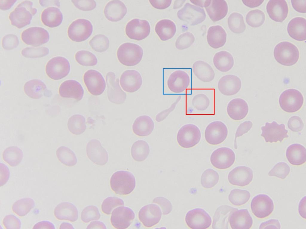 NCHforDocs's tweet image. #NCH_COTW The photomicrograph is from a stained peripheral blood smear from a patient with severe Iron deficiency anemia necessitating red blood cell (RBC) transfusion. What is the difference between the RBC in the red box and the one in the blue box? #PediPath #NCHPath