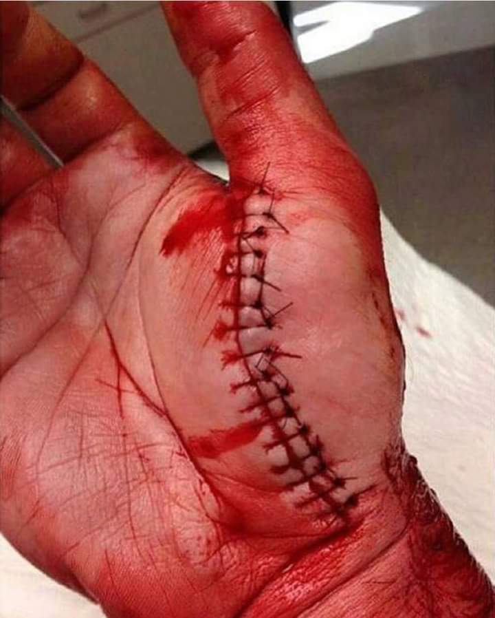 Tsuyu_sang's tweet image. มือใครไม่รู้ แต่เย็บสวยมากก 😮
#neatwork ทำไมชั้นชอบดูอะไรแบบนี้? 😳 #surgery #Medical