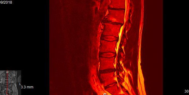 PTRClinic1's tweet image. #Backpain #DegenerativeDisc #poorhealth 
Advances in imaging #MRI and treatment 
#Physio #Chiropractic #Osteopathy 
Early intervention more affected than ignoring the symptoms 
#Painkillers and #backexercise are often inadequate 
Insist on referral to a specialised practitioner
