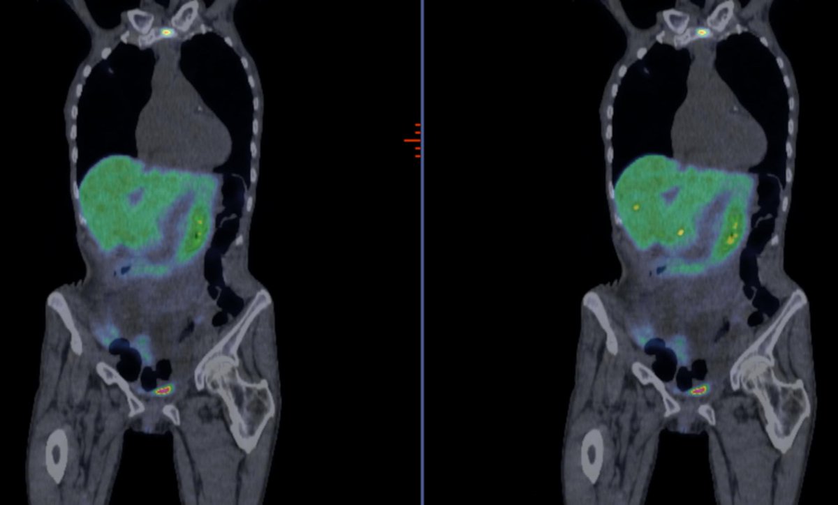 GEHealthCare's tweet image. Over 50% of all #PETCT procedures are impacted by #respiratory motion. This new technology allows #patients to breathe freely by automatically correcting for motion. invent.ge/2Cg1HUW