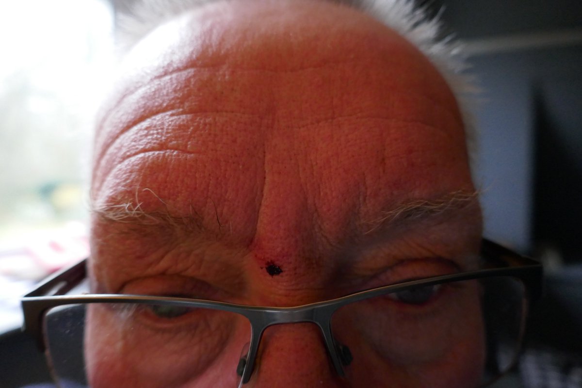 TheLengthsman's tweet photo. Got caught today right between the eyes ~ those #drainrods can be quite dangerous at times !
One for the #accidentbook
Never a nurse in the Parish when you want one ! https://t.co/RS5B31T1VA