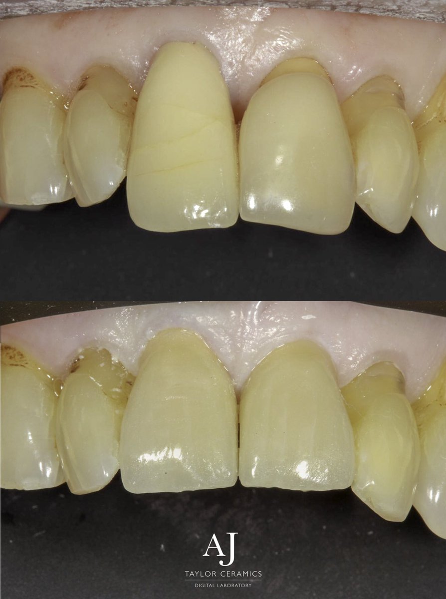 Replacing old crowns with a more natural look #dentistincardiff #digitaldentistry #CosmeticDentist #veneers #cardiff