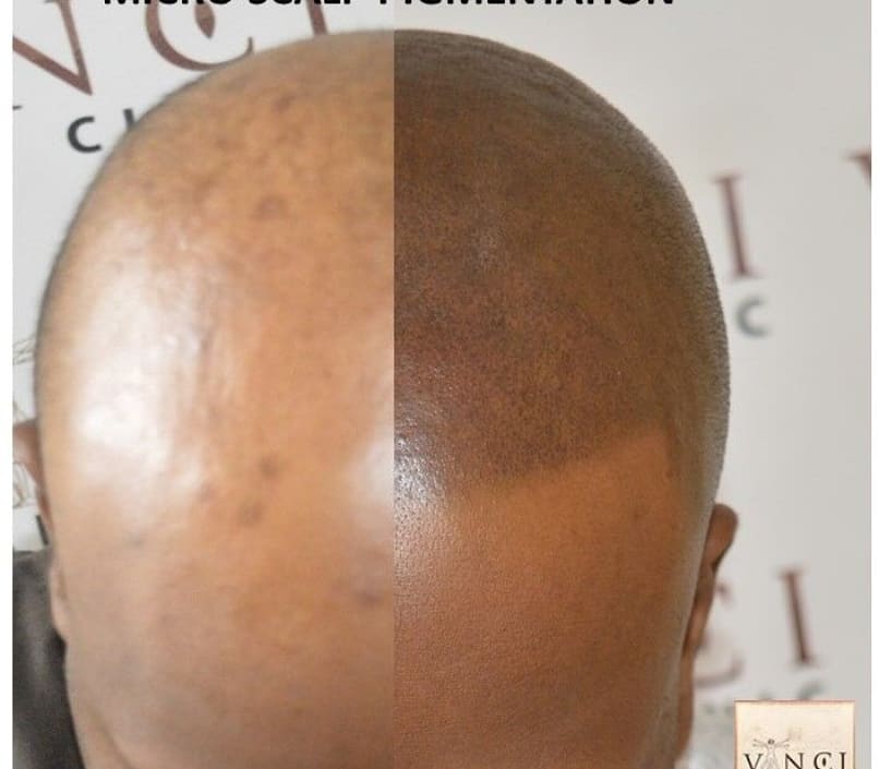 VinciHairNG's tweet image. Six things you&apos;ve always wanted to know about Micro Scalp Pigmentation (MSP), and why you probably need it. #issathread 

#MSP #microscalppigmentation #myhairlossstory #hairloss #losingmyedges #naturalhair #vincihairclinic #vincinigeria