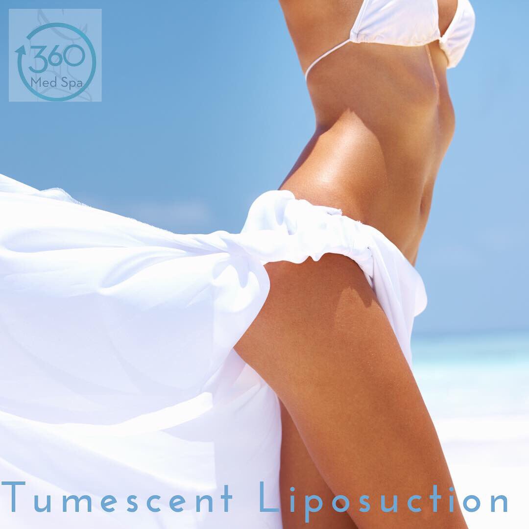 360Buford's tweet photo. Tumescent Liposuction safely removes superficial and deeper layers of fat with relatively little discomfort. With less bleeding and bruising patients heal faster and can walk immediately following surgery! Questions and free consultations: 770-932-2662. (1/2) https://t.co/uZQndparBt
