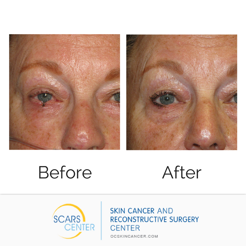 SCARSCenter's tweet image. The #eyes are extremely delicate and should be handled with care. Our talented and nimble #surgeons know just the treatments and techniques for even the smallest nooks and crannies. Call to schedule a consultation: (949) 719-1800
