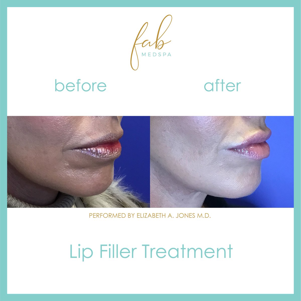 FabMedSpa's tweet image. More luscious lips from Dr. Jones👄👄👄 Get 5 Free Smooth Threads with any filler treatment throughout the month of March. Try out this dynamic duo of lip makeovers!  Click link for March promos.
fabmedspa-fw-tx.com/with/fab-med-s…
#smooththreads #filler #lipmakeover #fabmedspa #friendswood