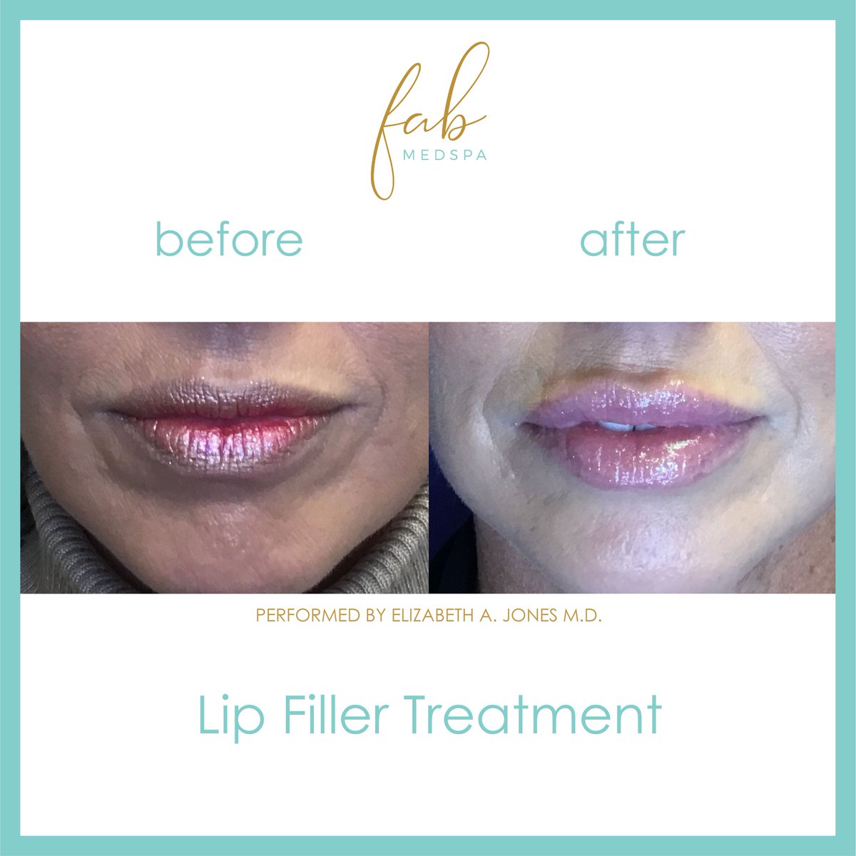FabMedSpa's tweet image. More luscious lips from Dr. Jones👄👄👄 Get 5 Free Smooth Threads with any filler treatment throughout the month of March. Try out this dynamic duo of lip makeovers!  Click link for March promos.
fabmedspa-fw-tx.com/with/fab-med-s…
#smooththreads #filler #lipmakeover #fabmedspa #friendswood