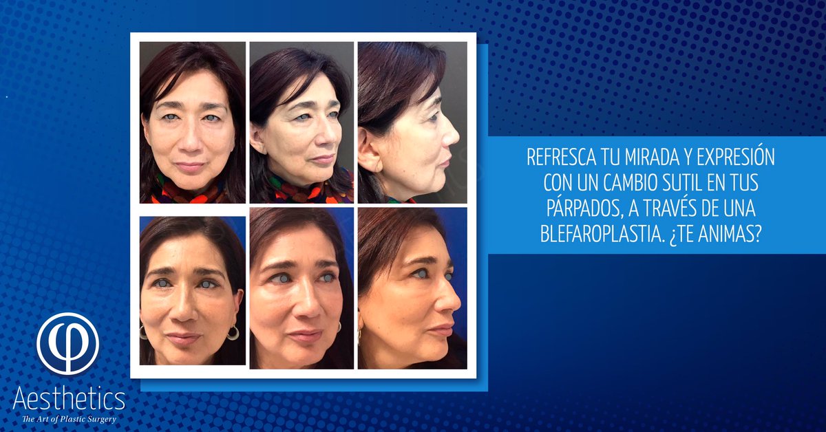 gjcplastico's tweet photo. Solucionar los párpados caídos con blefaroplastia hace que tu rostro luzca más juvenil y fresco. Te compartimos este procedimiento en el que apreciamos que un cambio sencillo tiene resultados espectaculares. ¡Decídete hoy mismo y haz tu cita de valoración!📱(477) 7132835 ✅ https://t.co/m3LaOBhotf