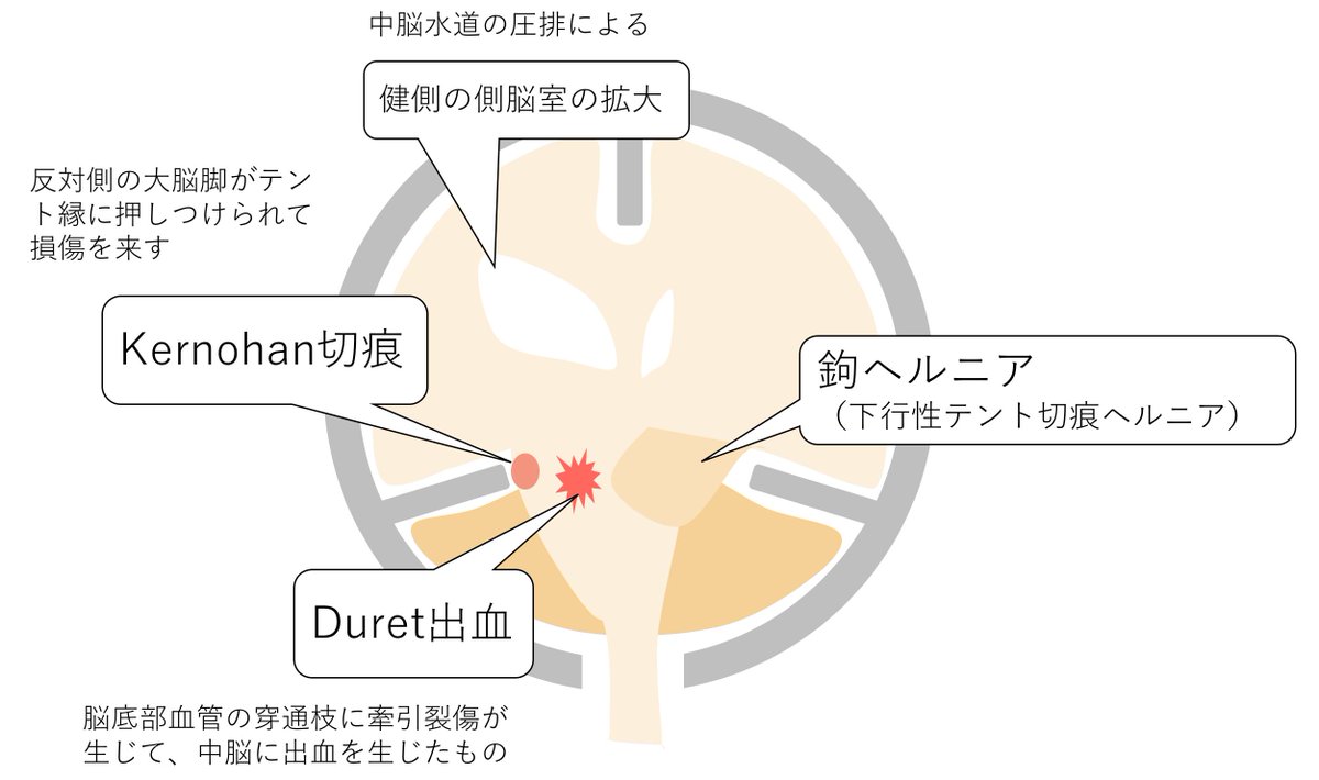 ヘルニア は 脳 と