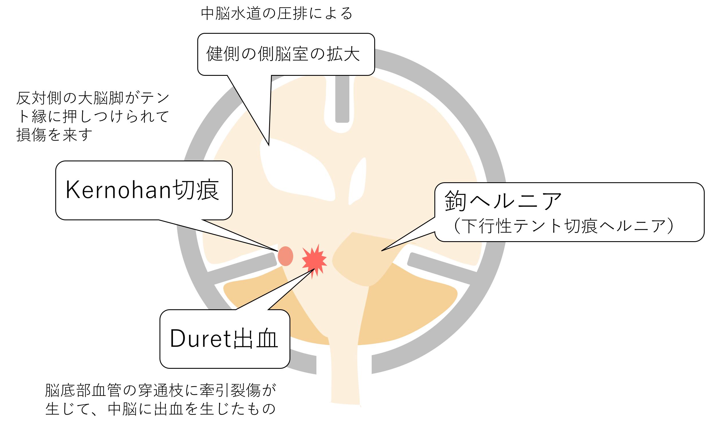 ごろ にゃ 画像診断cafe 鉤ヘルニア 下行性テント切痕ヘルニア が致死的となり得る理由と画像診断で見るべきポイント の イラストを作りました 頭部ct 救急医療 画像診断 Espresso救急画像診断 脳ヘルニア 救急画像 T Co Ynsbgfbfxa