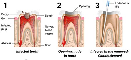 Why is root canal treatment so expensive? #dental #dentalhealth #dentalcare #Dentist #dentalconsultation #akjdental
akjdental.com/archives/5383