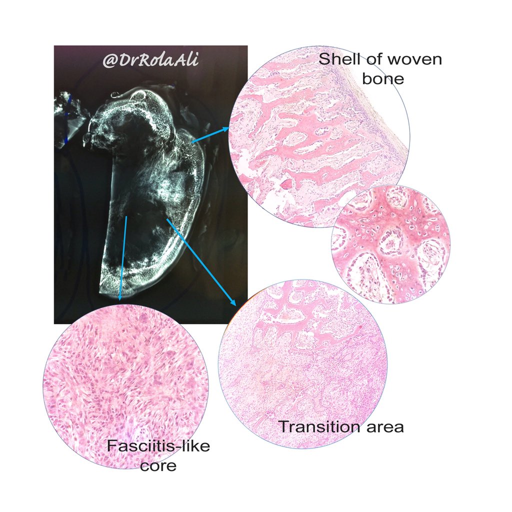 DrRolaAli's tweet photo. Yes, myositis ossificans. Related to nodular fasciitis and aneurysmal bone cyst as it harbors UPS6 rearrangement. @nusrat_xahra #tweetorial #pathologists #PathTweetAward #MSKPath #BSTPath #pathtwitter #pathology https://t.co/24a4ZTvLNh