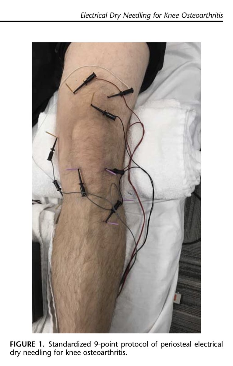 DrDunning's tweet photo. Rather than pricking knots (i.e. trigger points) in muscles with repeated pistoning, consider Periosteal Electrical Dry Needling for knee OA as an adjunct to exercise &amp; manual therapy... https://t.co/nAvmCeD2jF #AAMTFellowship After all, knee OA is a degenerative bone condition https://t.co/eSShgRZC2S