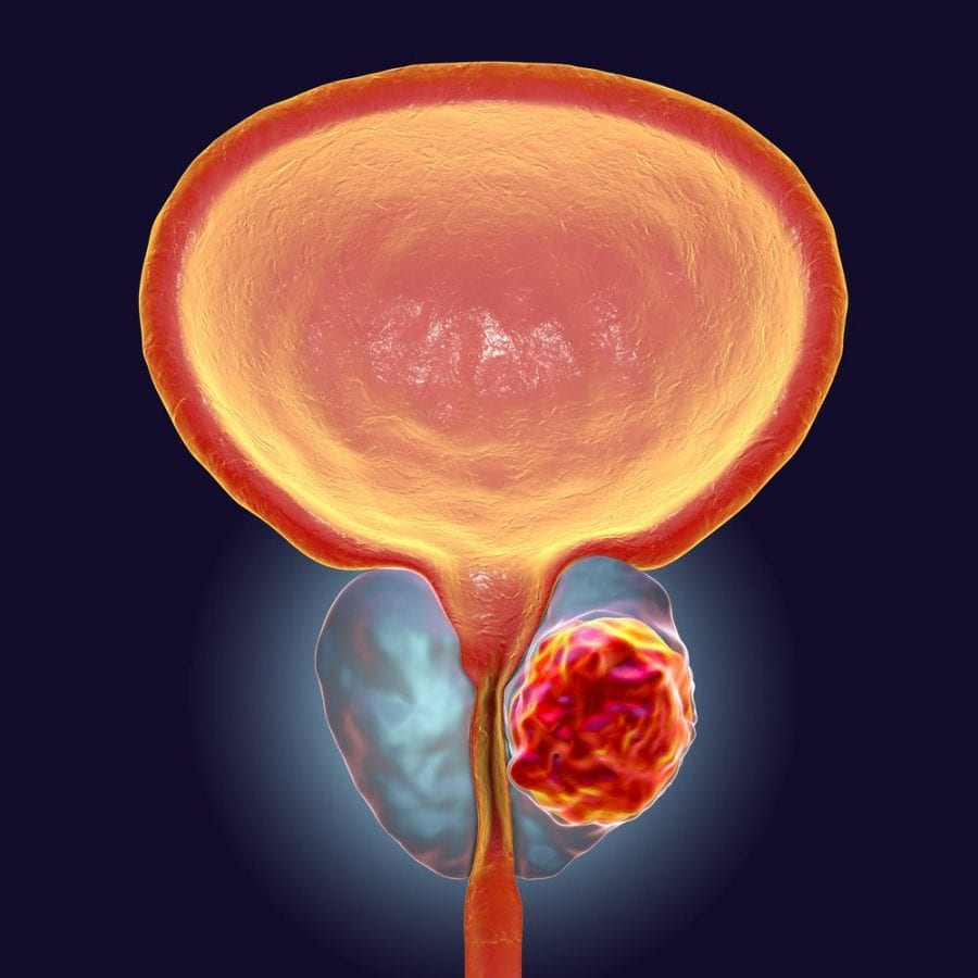 RxLeafMD's tweet photo. CBD and prostate cancer are bitter enemies. This cannabinoid is seriously kicking butt. https://t.co/PyBOrlSQwc #CBD #prostatecancer #goodmedicine #killigit #cancersucks #rxleafmd https://t.co/M7ketVAZNX