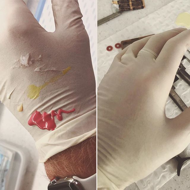 DrBenSellick's tweet photo. What my glove looks like during the last 10min of analogue workflow: Polyether, Vaseline, PVS bite reg material, Protemp, Tempbond ...
Versus ...
What my glove looks like during an intra-oral scan
🤷🏼‍♂️ Both work well when you know what to do. But one is… https://t.co/z7HDLXNe5v https://t.co/Sl7RSSftT2