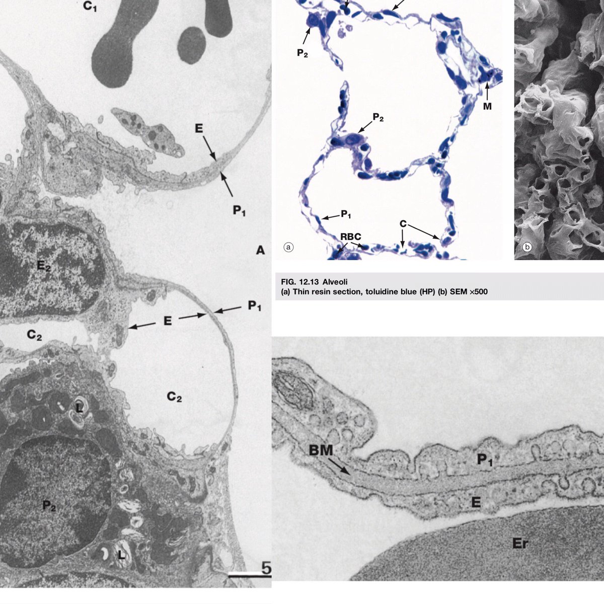 AAPAstudents's tweet image. 🔬Micro time! These are #lung #micrographs - can you identify alveoli, RBCs, and capillaries? Type I pneumocytes are large, flat, and are the barrier for gas exchange. Type II are cuboidal, produce surfactant, and are stem cells. Photos from Wheater’s Functional #Histology.