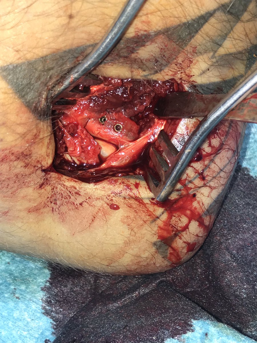 DrSanchezAngulo's tweet photo. #fractura de cabeza del #radio sintetizada con 2 #tornillos de 2,5mm.

👉🏼Cuando operarlas? en pacientes con fracturas conminutas o parcelares con bloqueo de la pronosupinacion. 

👉🏼Lo más importante es una #osteosintesis precoz y estable que permita #rehabilitación #precoz https://t.co/blT5IGuEGq