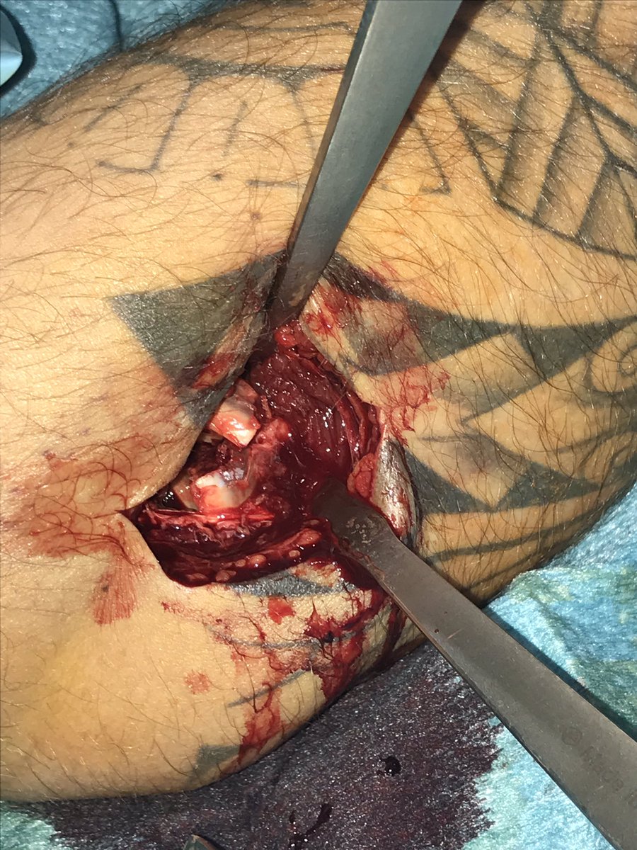 DrSanchezAngulo's tweet photo. #fractura de cabeza del #radio sintetizada con 2 #tornillos de 2,5mm.

👉🏼Cuando operarlas? en pacientes con fracturas conminutas o parcelares con bloqueo de la pronosupinacion. 

👉🏼Lo más importante es una #osteosintesis precoz y estable que permita #rehabilitación #precoz https://t.co/blT5IGuEGq