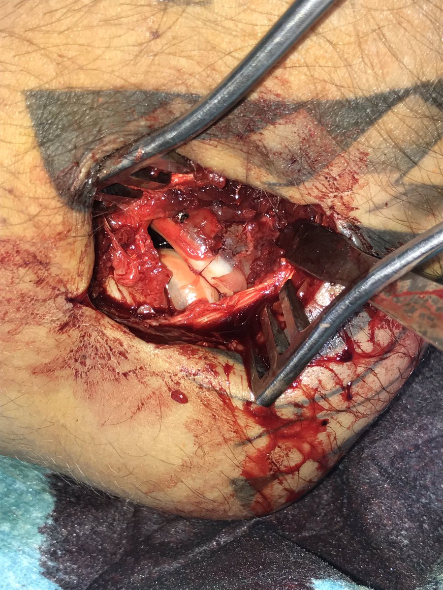 DrSanchezAngulo's tweet photo. #fractura de cabeza del #radio sintetizada con 2 #tornillos de 2,5mm.

👉🏼Cuando operarlas? en pacientes con fracturas conminutas o parcelares con bloqueo de la pronosupinacion. 

👉🏼Lo más importante es una #osteosintesis precoz y estable que permita #rehabilitación #precoz https://t.co/blT5IGuEGq